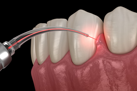 レーザー照射のイメージ