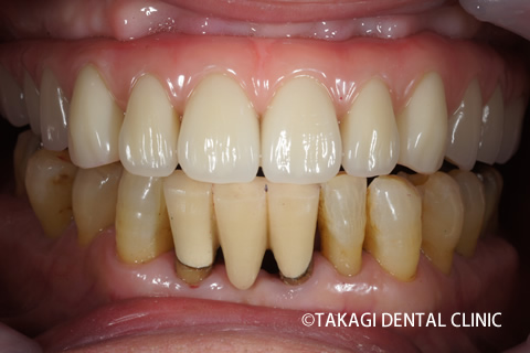 オールオン4術後