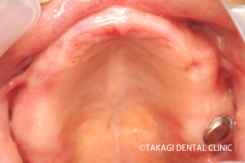 オールオン4術前無歯顎