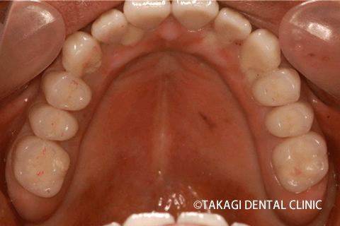 オールオン4術後上顎
