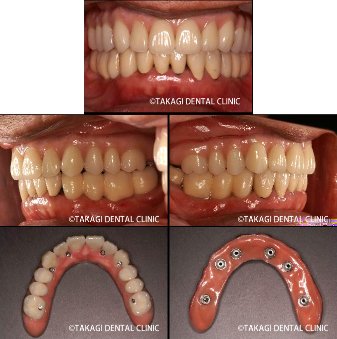 オールオン4上部構造