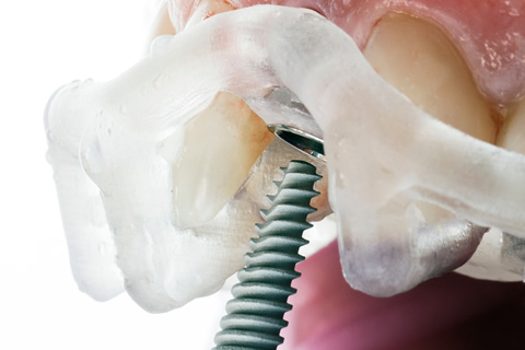 ガイデッドサージェリー