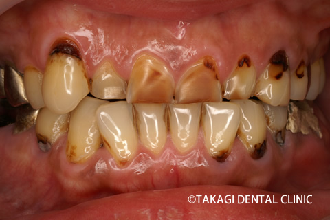 虫歯ボロボロ術前