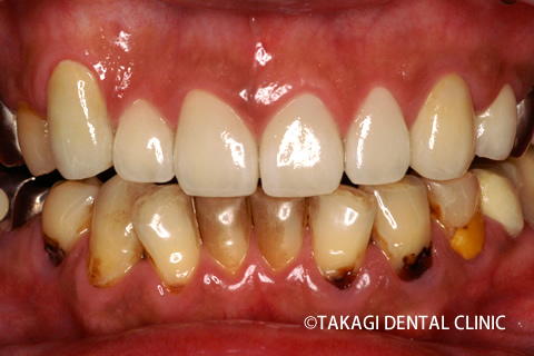 虫歯ボロボロ術後